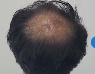 DMMオンラインクリニックの発毛ライトプラン治療前の症例画像
