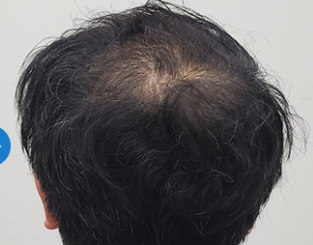 DMMオンラインクリニックの発毛ライトプラン治療後3ヶ月の症例画像