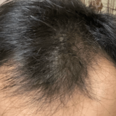 クリニックフォアの発毛ベーシックプラン治療後4ヶ月の症例画像