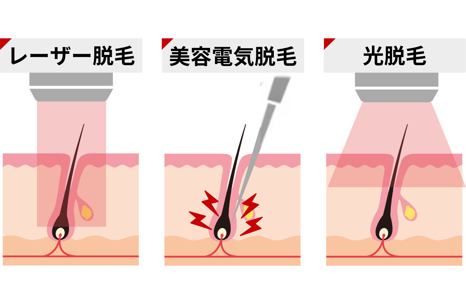 ヒゲの脱毛方法