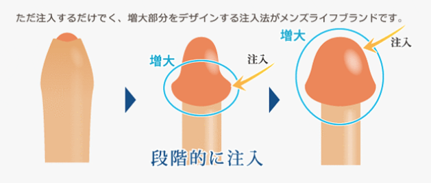 メンズライフクリニックの亀頭増大術に関するイラスト画像