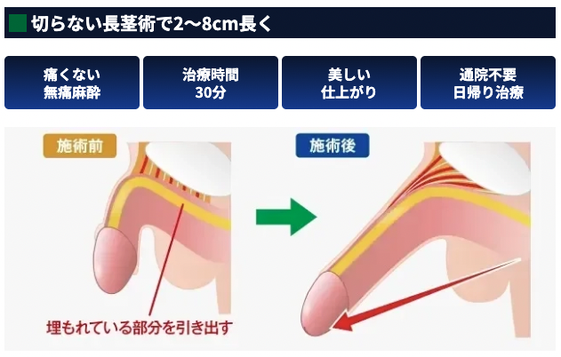MSクリニックの長茎術の2〜8cm伸びる切らない長茎術のイラスト画像