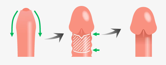皐月クリニックの包茎手術に関するイラスト画像