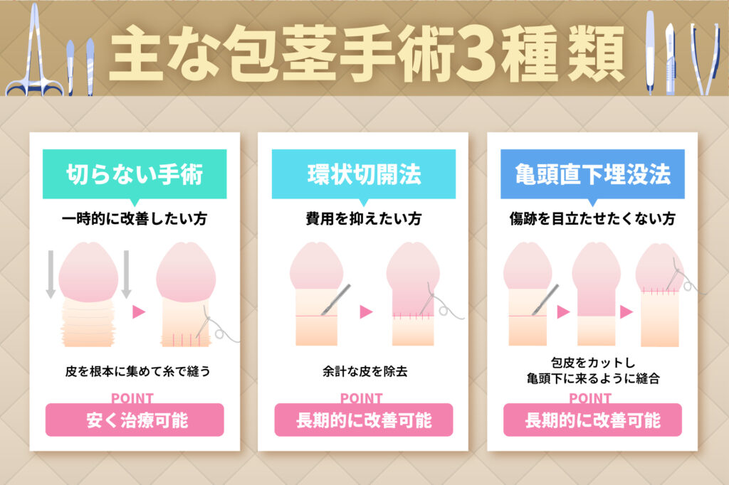 主な包茎手術3種類を表したイラスト画像