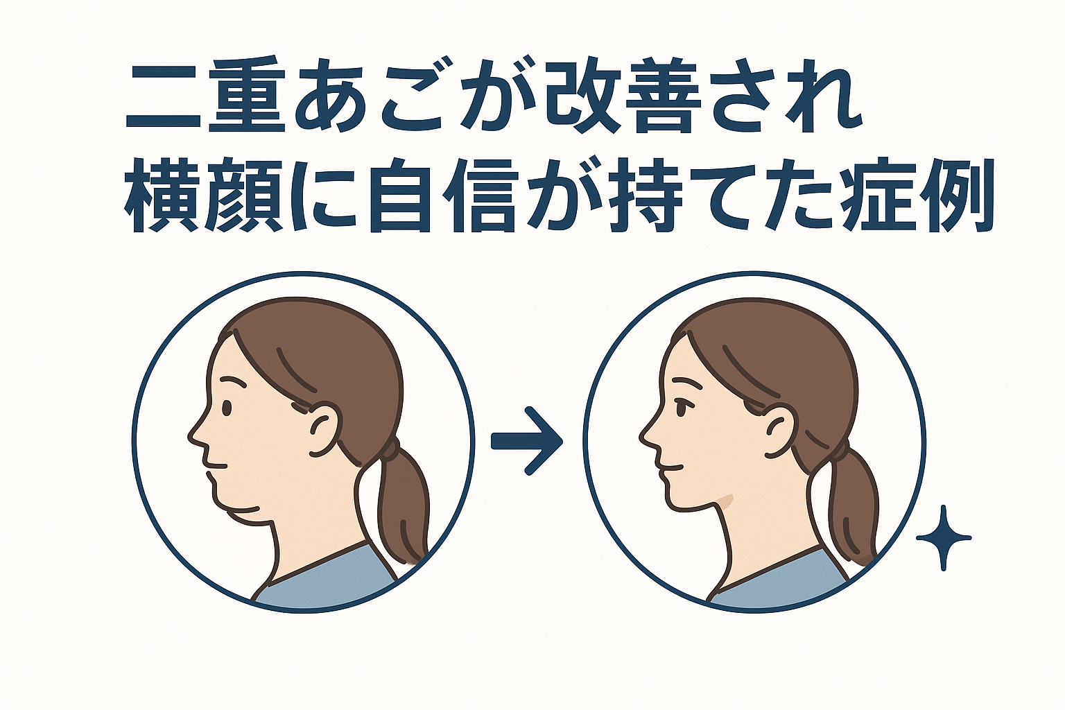 二重あごが改善され横顔に自信が持てた症例