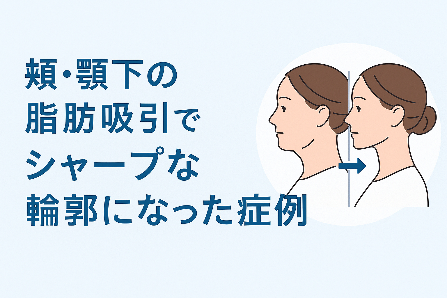 頬・顎下の脂肪吸引でシャープな輪郭になった症例